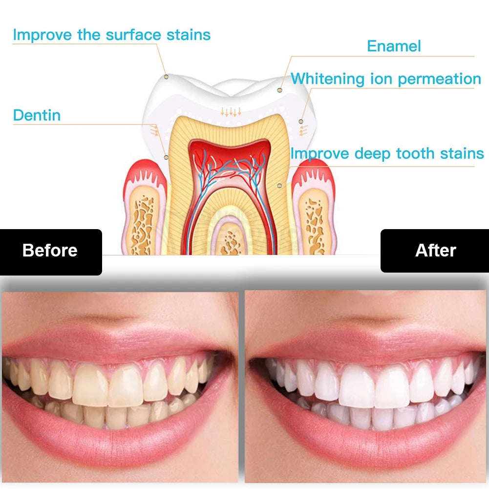WhiteGlow Teeth Whitening Set with LED Light, Whitening Pen & Tray